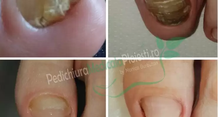 Îngrijirea/curățarea unghiilor îngroșate, denivelate, unghiilor micotice