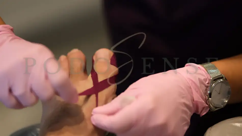 Pedichiura medicala Ploiesti | PodoSense Pedichiura medicala Ploiesti | PodoSense