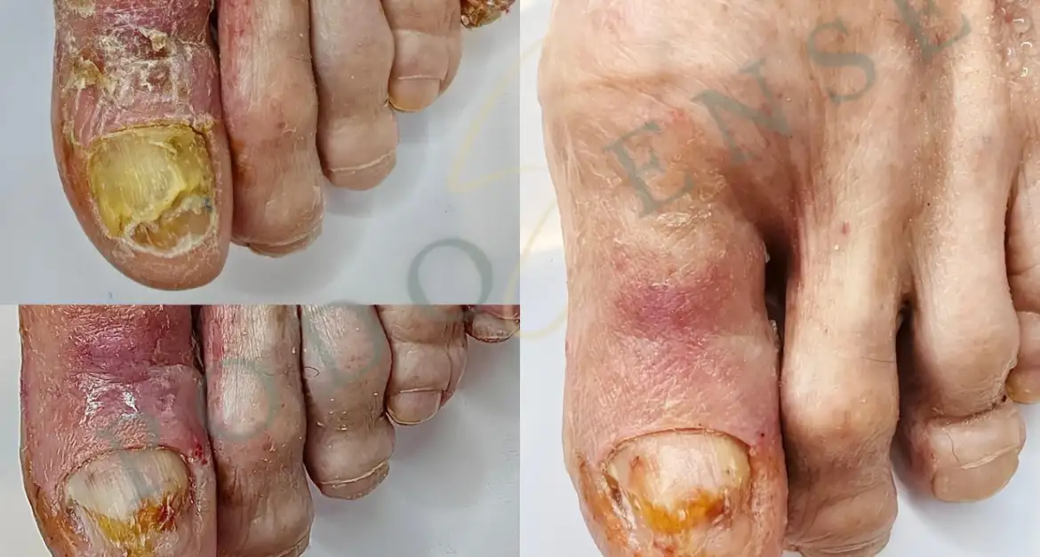 Piciorul diabetic începe cu o rană mică și se poate termina cu o amputare