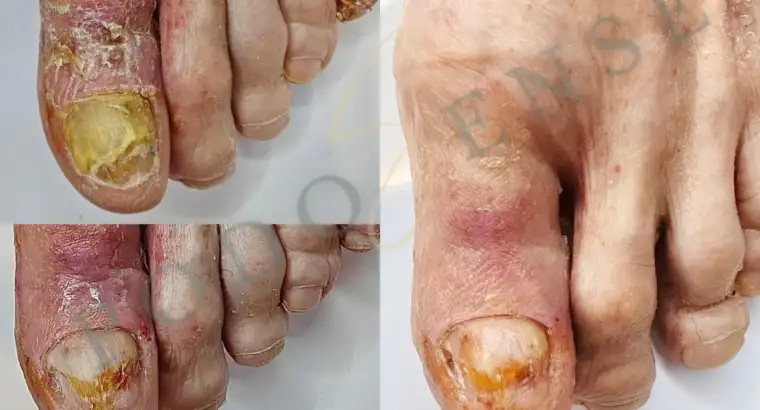 Piciorul diabetic începe cu o rană mică și se poate termina cu o amputare