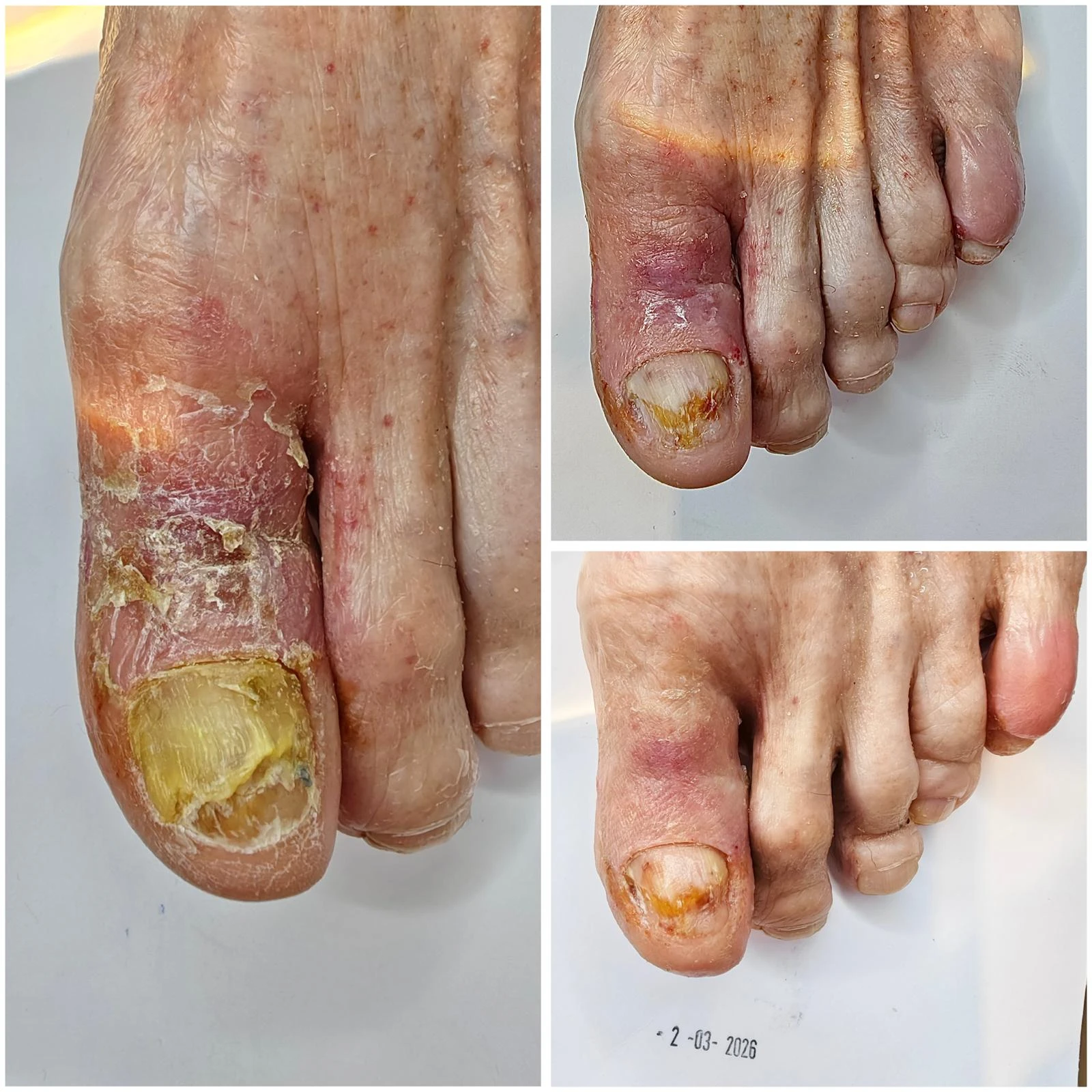 Piciorul diabetic