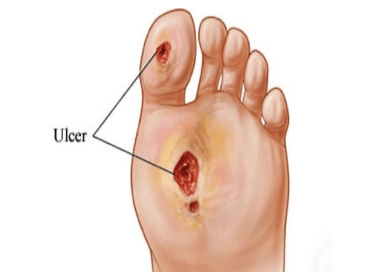 Ulcer picior diabetic
