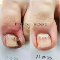 Studiu de caz clinic: Corecția unghiei încarnate cu SinBrace