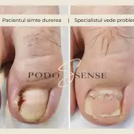 Ce observă pacientul și ce vede specialistul în pedichiura medicală