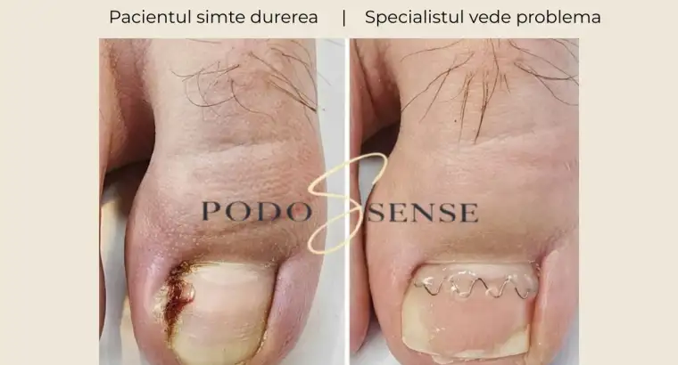 Ce observă pacientul și ce vede specialistul în pedichiura medicală